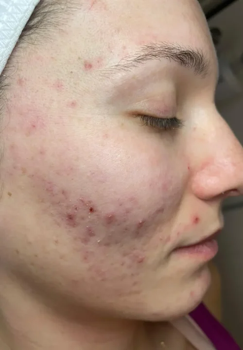 ANTES TTO ACNE LARISSA (1)