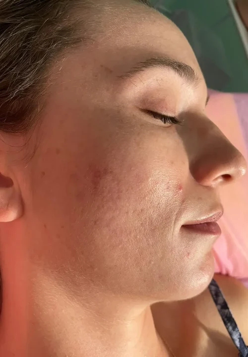 DESPUES DE TRATAMIENTO ACNE LARISSA (1)
