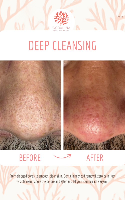 blackhead removal
